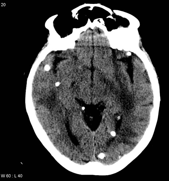 File:Neurocysticercosis (Radiopaedia 7773-8596 non-contrast 4).jpg