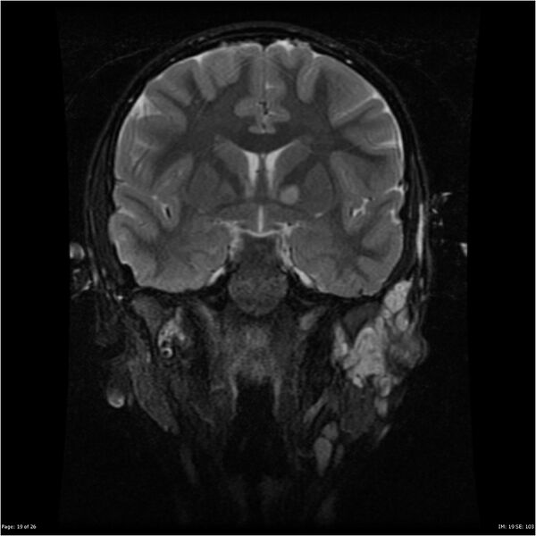 File:Neurofibromatosis type 1 (Radiopaedia 22541-22564 Coronal T2 fat sat 10).jpg