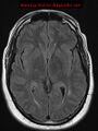 Neuroglial cyst (Radiopaedia 10713-11184 Axial FLAIR 12).jpg