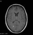 Neurosarcoidosis (Radiopaedia 10930-11351 Axial T1 C+ 11).jpg