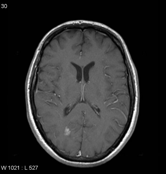 File:Neurosarcoidosis (Radiopaedia 10930-11351 Axial T1 C+ 11).jpg