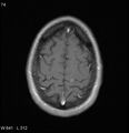 Neurosarcoidosis (Radiopaedia 10930-17204 Axial T1 C+ 17).jpg