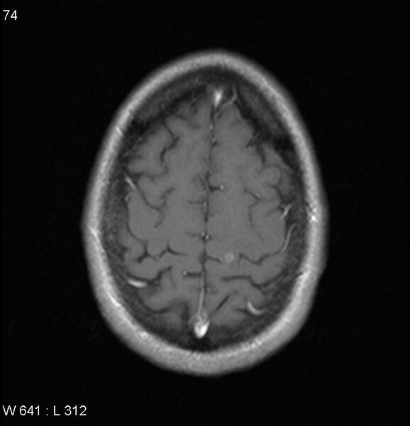 File:Neurosarcoidosis (Radiopaedia 10930-17204 Axial T1 C+ 17).jpg