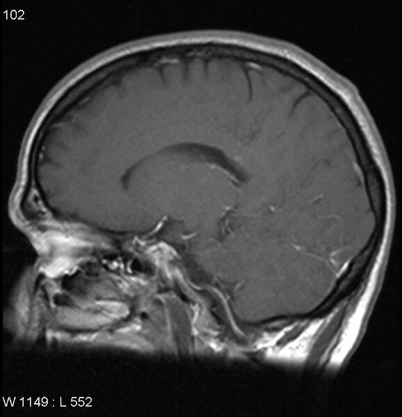 File:Neurosarcoidosis (Radiopaedia 10930-17204 Sagittal T1 C+ 7).jpg