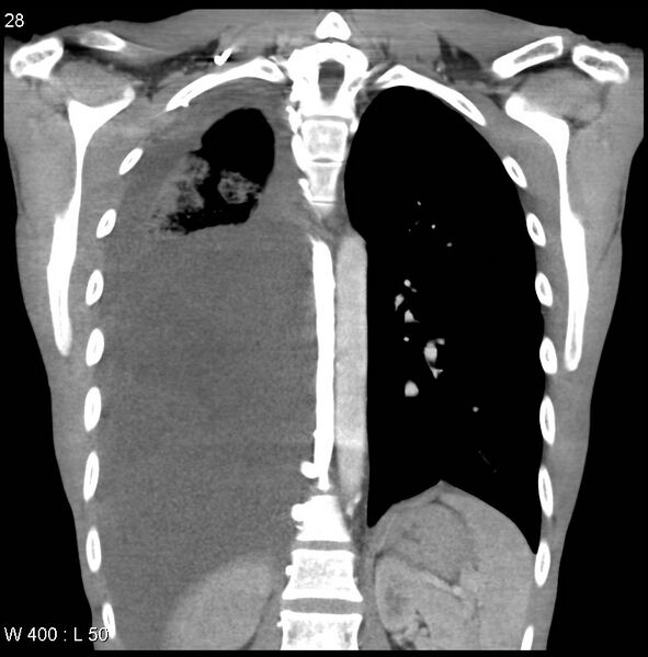 File:Non-Hodgkin lymphoma involving lung (Radiopaedia 29094-29470 C 22).jpg
