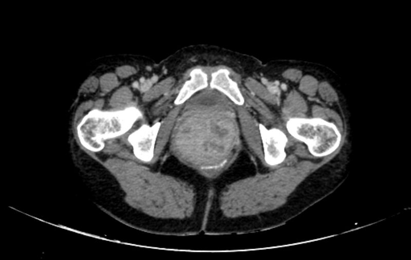 File:Non-puerperal uterine inversion (Radiopaedia 78343-91094 A 84).jpg
