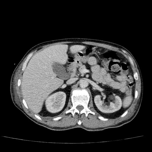 File:Non small-cell lung cancer (Radiopaedia 24467-24769 C+ delayed 66).jpg