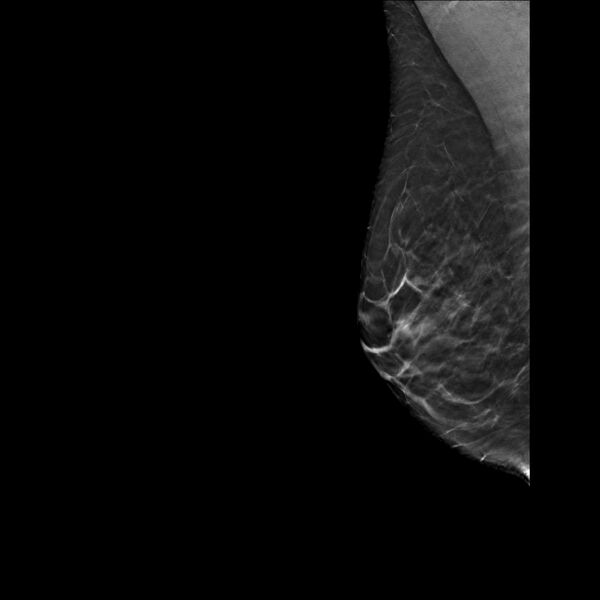 File:Normal breast mammography (tomosynthesis) and ultrasound (Radiopaedia 65325-74353 RMLO Tomo 19).jpeg