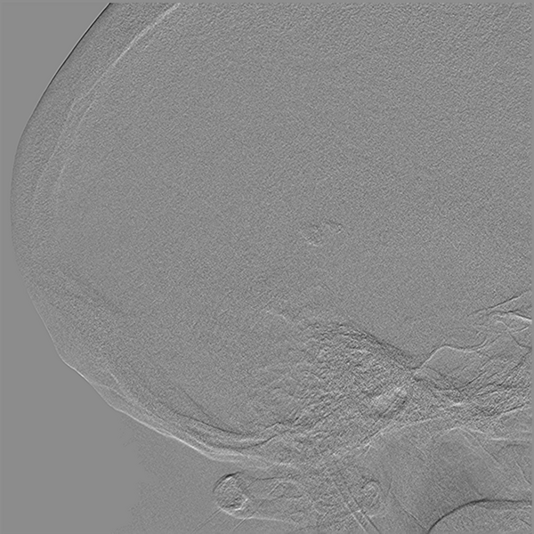 File:Normal cerebral angiogram (four vessel DSA) (Radiopaedia 41708-44649 L 4).png