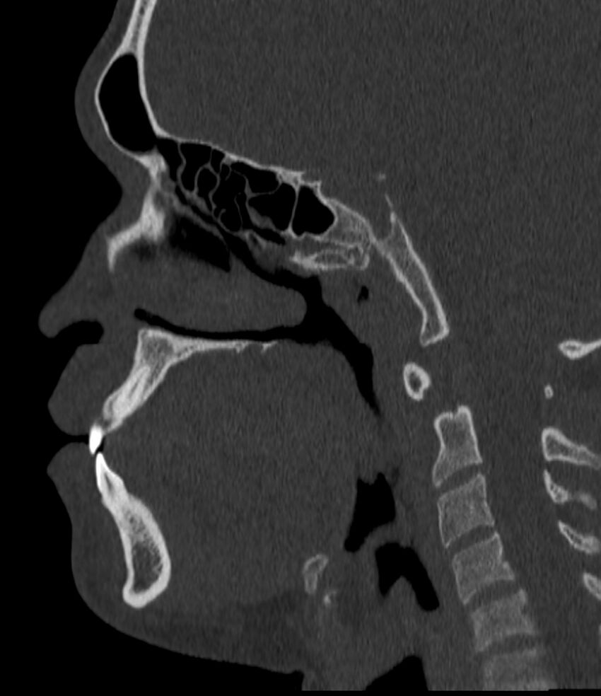 Normal facial bone CT (Radiopaedia 88742-105476 Sagittal bone window 95).jpg