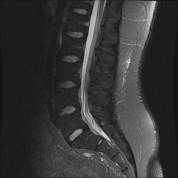 File:Normal lumbar spine MRI (Radiopaedia 43051-46311 Sagittal STIR 10).jpg