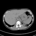 Normal multiphase CT liver (Radiopaedia 38026-39996 Axial non-contrast 14).jpg