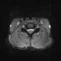 Normal trauma cervical spine (Radiopaedia 41017-43762 Axial T2 17).png