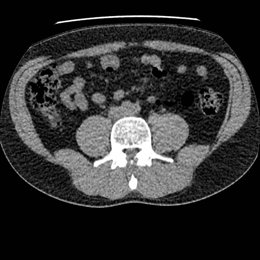 Obstructing ureteric calculus and ureteric anatomy (Radiopaedia 62730-71042 Axial non-contrast 81).jpg