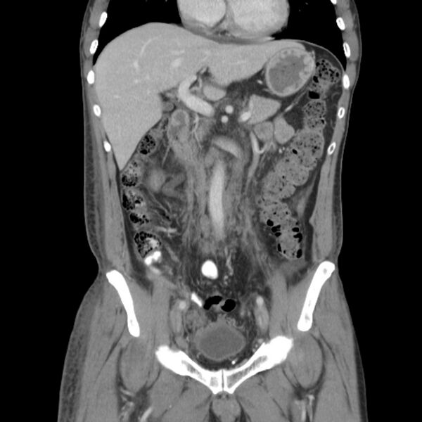 File:Obstructive bladder transitional cell carcinoma (Radiopaedia 9825-10410 B 8).jpg