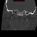 Occipital condyle fracture (Radiopaedia 18366-18208 Coronal bone window 1).jpg