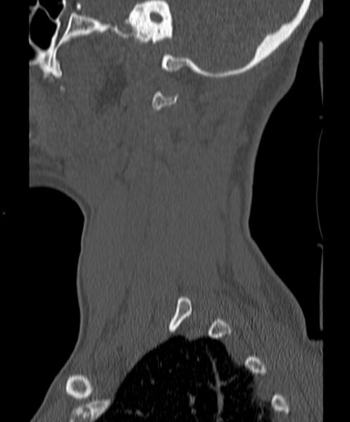File:Occipital condyle fracture (Radiopaedia 61165-69056 Sagittal bone window 5).jpg