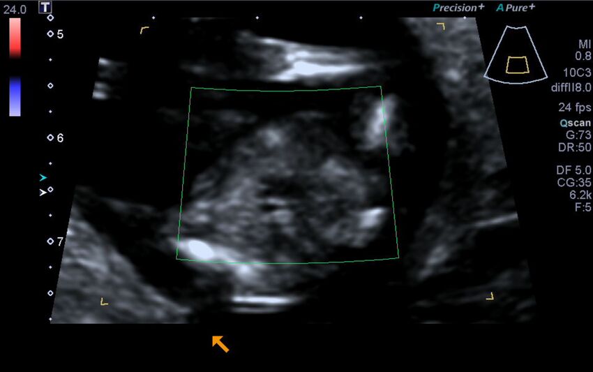 1st trimester nuchal-morphology ultrasound (Radiopaedia 44706-48477 Heart views cine with colour 185).jpg