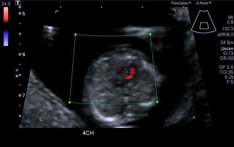 File:1st trimester nuchal-morphology ultrasound (Radiopaedia 44706-48477 Heart views cine with colour 42).jpg