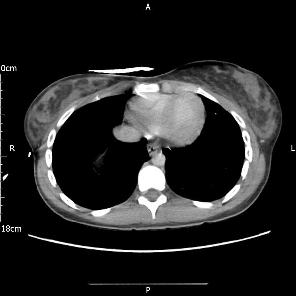 File:AAST grade IV kidney injury with CEUS follow-up (Radiopaedia 72353-82877 Axial C+ portal venous phase 3).jpg