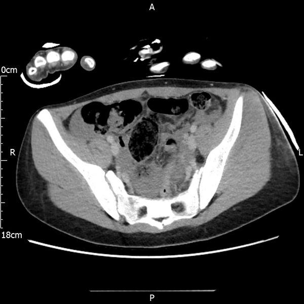 File:AAST grade IV kidney injury with CEUS follow-up (Radiopaedia 72353-82877 Axial C+ portal venous phase 60).jpg