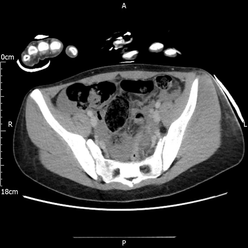 AAST grade IV kidney injury with CEUS follow-up (Radiopaedia 72353-82877 Axial C+ portal venous phase 60).jpg