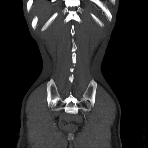 File:Abdominal aortic aneurysm (Radiopaedia 23703-23856 Coronal C+ arterial phase 34).jpg