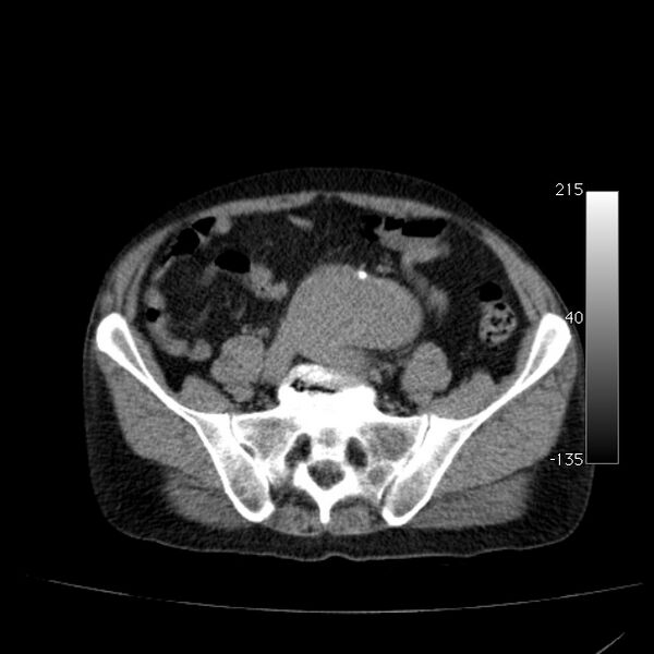 File:Abdominal aortic aneurysm (Radiopaedia 29248-29660 Axial non-contrast 41).jpg