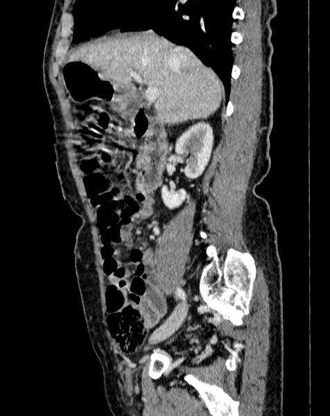 File:Abdominal aortic aneurysm (Radiopaedia 83581-98689 Sagittal C+ portal venous phase 14).jpg