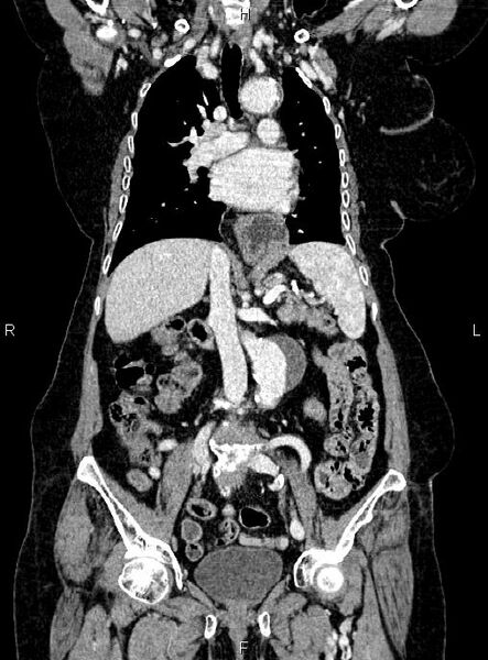 File:Abdominal aortic aneurysm (Radiopaedia 85063-100606 Coronal C+ arterial phase 28).jpg