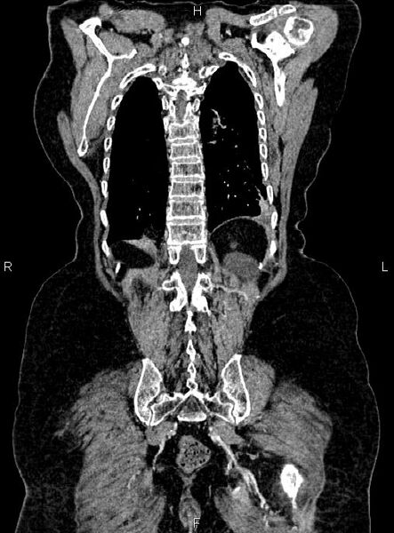 File:Abdominal aortic aneurysm (Radiopaedia 85063-100606 Coronal C+ arterial phase 50).jpg