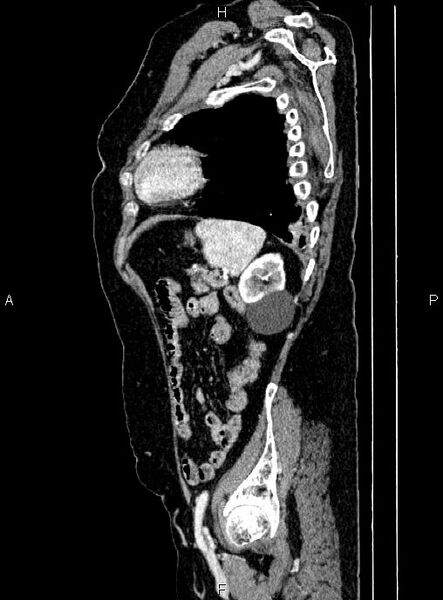 File:Abdominal aortic aneurysm (Radiopaedia 85063-100606 Sagittal C+ arterial phase 66).jpg
