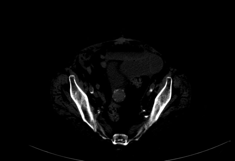 File:Abdominal aortic aneurysm - impending rupture (Radiopaedia 19233-19246 B 53).jpg