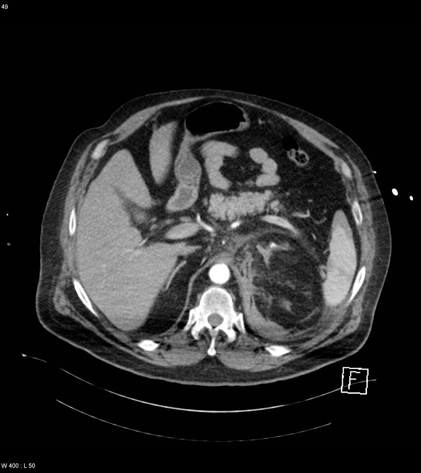Abdominal aortic aneurysm with intramural hematoma then rupture (Radiopaedia 50278-55632 Axial C+ arterial phase 48).jpg