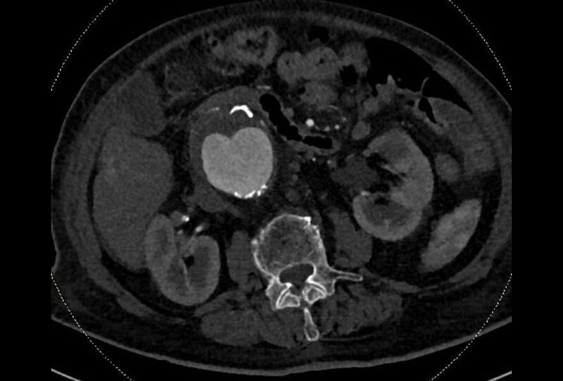 File:Abdominal aortic aneurysm with thrombus fissuration (Radiopaedia 73192-83919 Axial C+ arterial phase 74).jpg