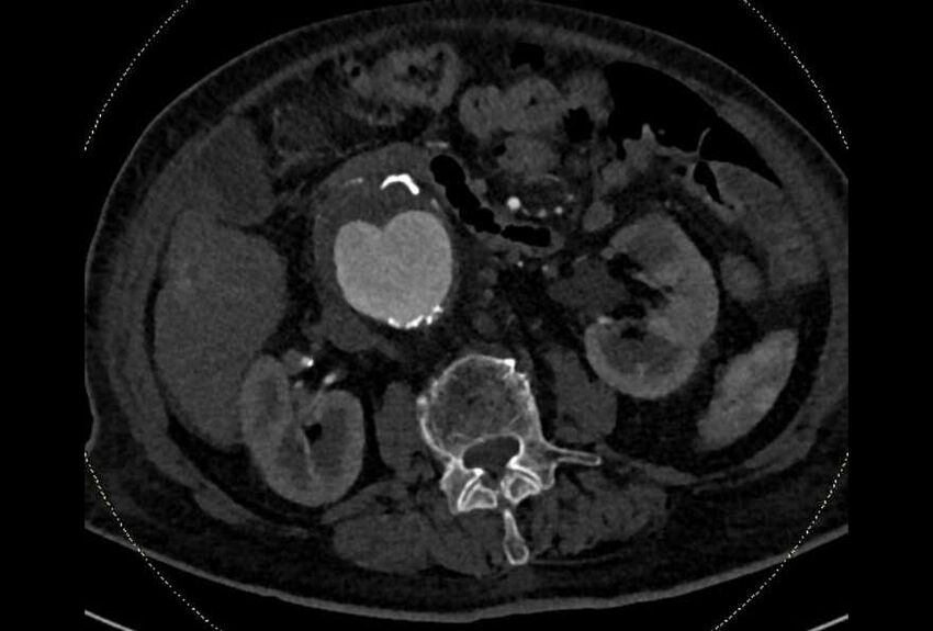 Abdominal aortic aneurysm with thrombus fissuration (Radiopaedia 73192-83919 Axial C+ arterial phase 74).jpg