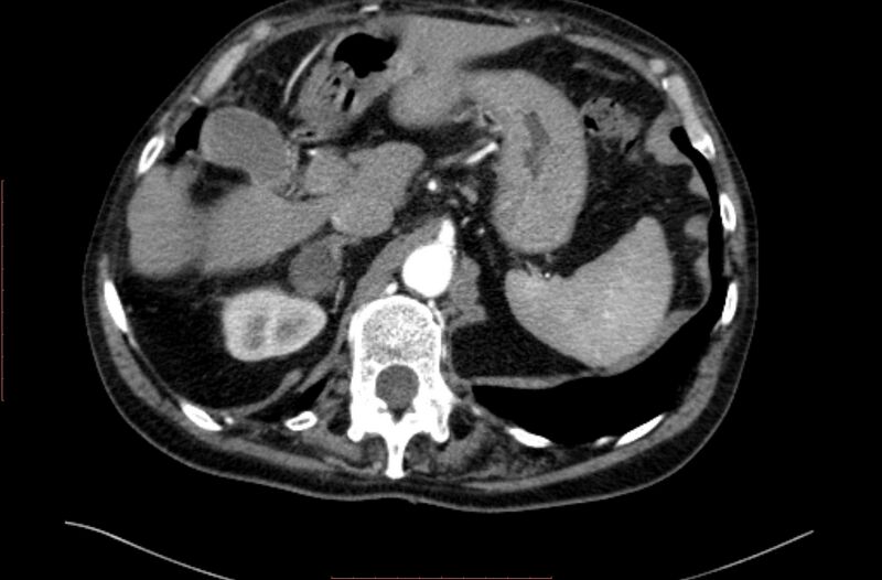 File:Abdominal aortic interposition tube graft and aneurysm thrombosis (Radiopaedia 71438-81857 Axial C+ arterial phase 12).jpg