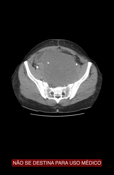 File:Abdominal desmoid tumor (Radiopaedia 44024-47540 Axial C+ arterial phase 36).jpg