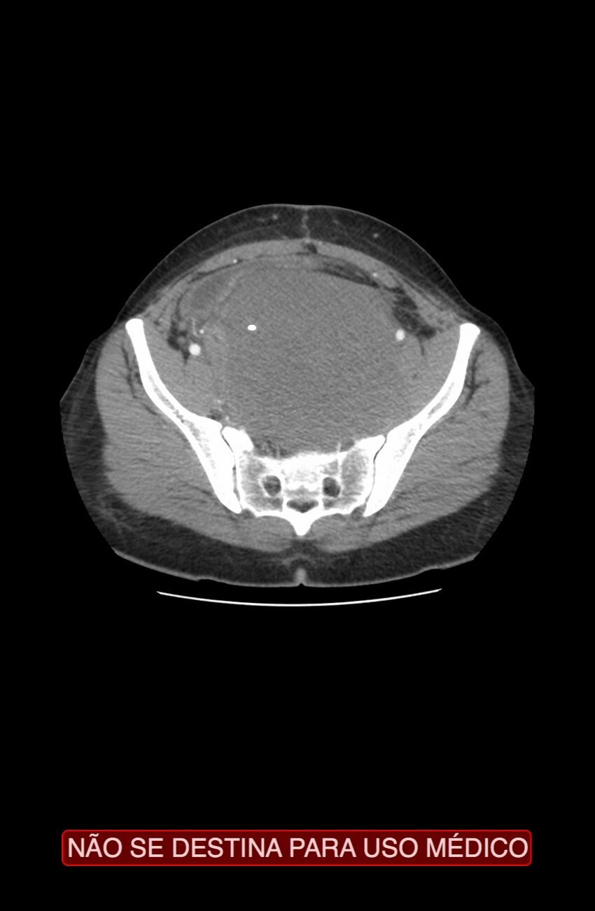 Abdominal desmoid tumor (Radiopaedia 44024-47540 Axial C+ arterial phase 36).jpg