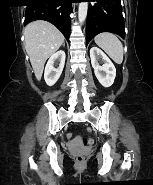 File:Active Crohn disease (Radiopaedia 59394-66750 Coronal C+ portal venous phase 49).jpg