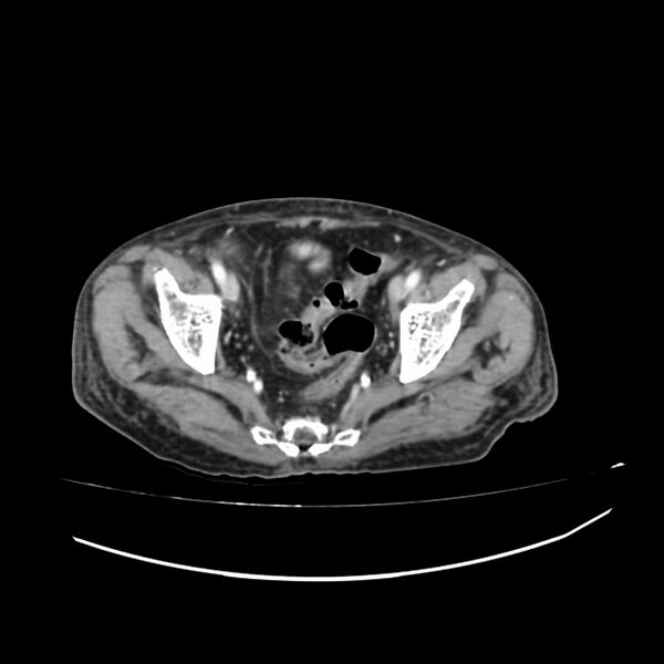 File:Acute-on-chronic Crohn disease with enteroenteric fistula (Radiopaedia 66686-75987 B 69).jpg