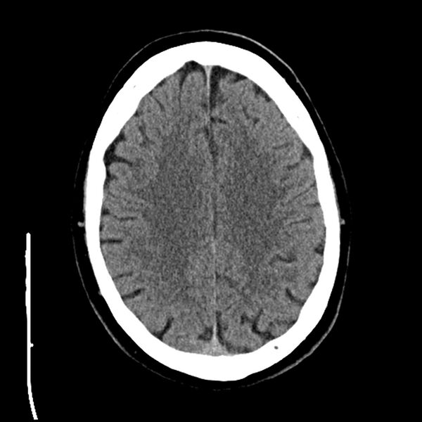 File:Acute A3 occlusion with ACA ischemic penumbra (CT perfusion) (Radiopaedia 72036-82525 Axial non-contrast 31).jpg
