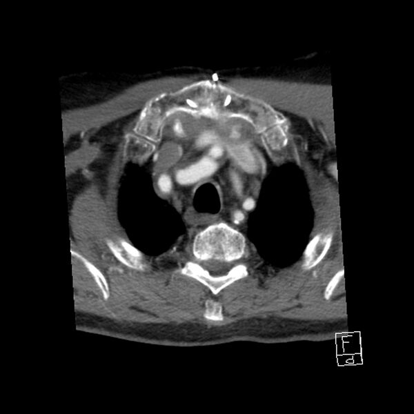 File:Acute ICA ischemic penumbra due to high-grade CCA stenosis (CT perfusion) (Radiopaedia 72038-82530 Axial C+ arterial phase 73).jpg