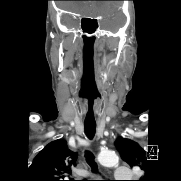 File:Acute ICA ischemic penumbra due to high-grade CCA stenosis (CT perfusion) (Radiopaedia 72038-82530 Coronal C+ arterial phase 16).jpg