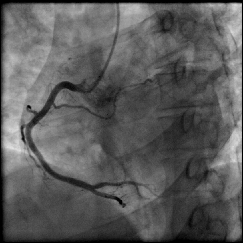 Acute anteroseptal myocardial infarction (Radiopaedia 68409-77946 RAO straight RCA 24).jpg