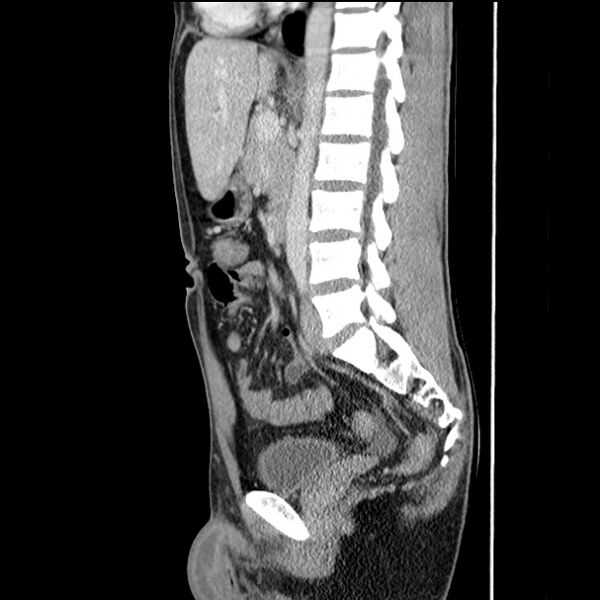 File:Acute appendicitis (Radiopaedia 27049-27227 Sagittal C+ portal venous phase 43).jpg