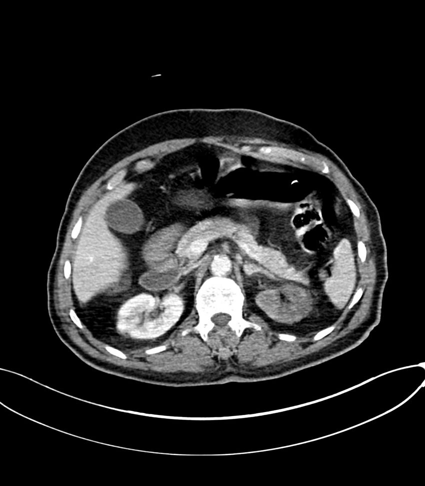 Acute arterial mesenteric ischemia (Radiopaedia 78238-90828 Axial C+ portal venous phase 46).jpg