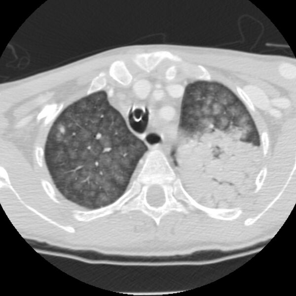File:Acute diffuse alveolar hemorrhage (Radiopaedia 41323-44158 Axial lung window 10).jpg