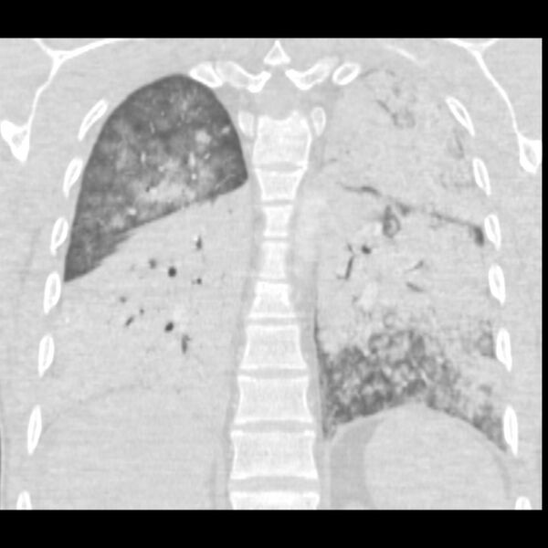 File:Acute diffuse alveolar hemorrhage (Radiopaedia 41323-44158 Coronal lung window 40).jpg