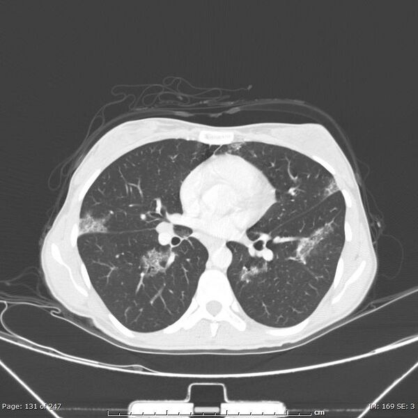 File:Acute eosinophilic pneumonia (Radiopaedia 48211-53073 Axial lung window 47).jpg